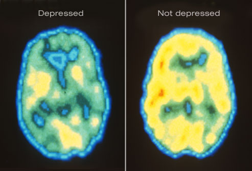 Soubor:Princ rm pet scan of depressed brain.jpg