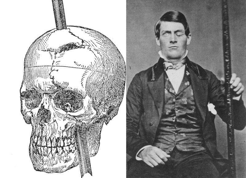 Soubor:Phineas-Gage-with-skull-picture.png